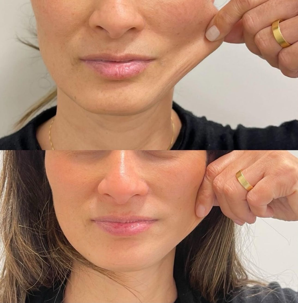 Sculptra