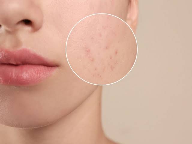 Tratamiento de Acné - Rostro, Cuello y Espalda